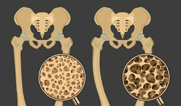 Phân biệt nhuyễn xương và loãng xương