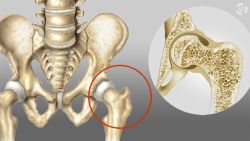 Sử dụng steroid có thể dẫn đến loãng xương