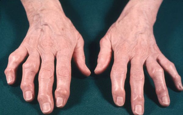 Biến dạng bàn tay do viêm khớp dạng thấp điều trị bằng cách nào?