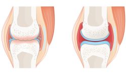 Phân biệt viêm khớp dạng thấp và thoái hóa khớp