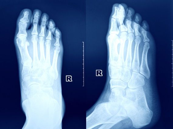 Những điều cần biết về gãy xương do mỏi ở bàn chân