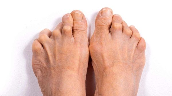 Các triệu chứng viêm khớp dạng thấp ở bàn chân