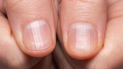 Triệu chứng bệnh viêm khớp dạng thấp ở móng tay, móng chân