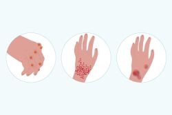 Những vấn đề về da liên quan đến bệnh viêm khớp dạng thấp