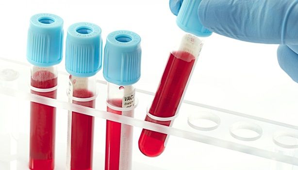 Các xét nghiệm máu chẩn đoán bệnh viêm khớp dạng thấp