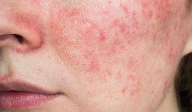 Mãn kinh ảnh hưởng như thế nào đến bệnh trứng cá đỏ (rosacea)??