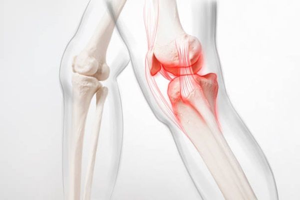 Phòng ngừa mòn xương do viêm khớp dạng thấp