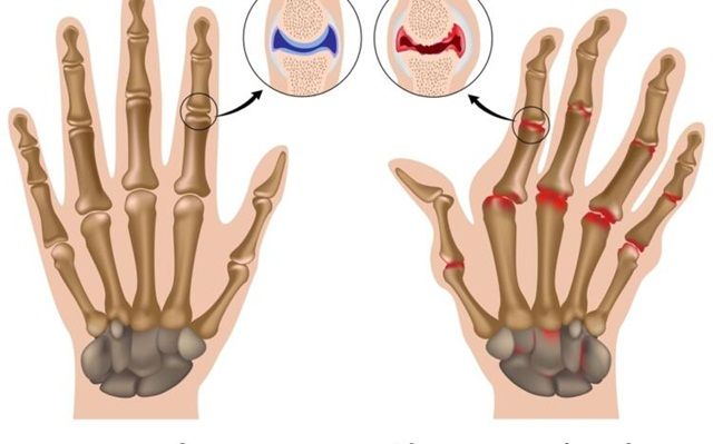 Làm thế nào để làm chậm sự tiến triển của bệnh viêm khớp dạng thấp?