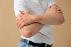 Mối liên hệ giữa bệnh vảy nến và viêm khớp dạng thấp
