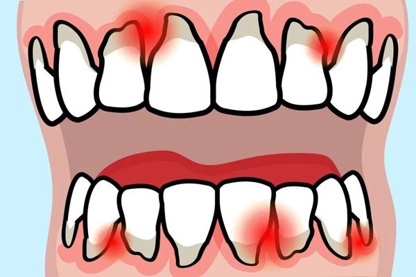Viêm khớp dạng thấp ảnh hưởng như thế nào đến xương hàm và răng?