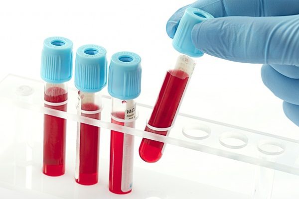 6 xét nghiệm máu giúp chẩn đoán bệnh viêm khớp dạng thấp