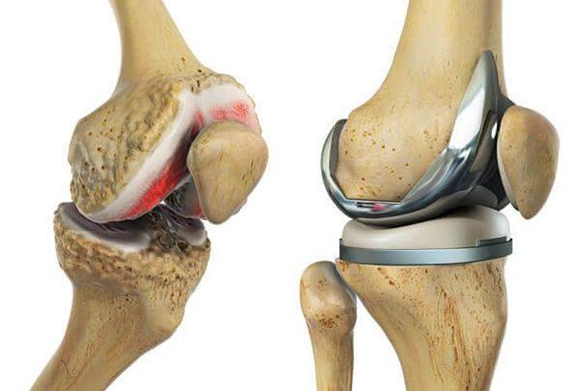 Khi nào cần thay khớp gối toàn phần?