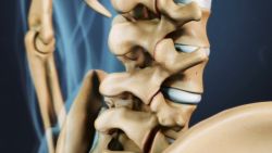 Thoái hóa cột sống: Nguyên nhân, triệu chứng và cách điều trị