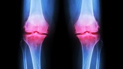 Thế nào là thoái hóa khớp nguyên phát và thoái hóa khớp thứ phát?