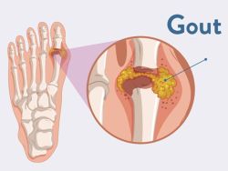 Điều trị và phòng ngừa bệnh gout