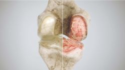 Viêm khớp gối: Triệu chứng và cách điều trị