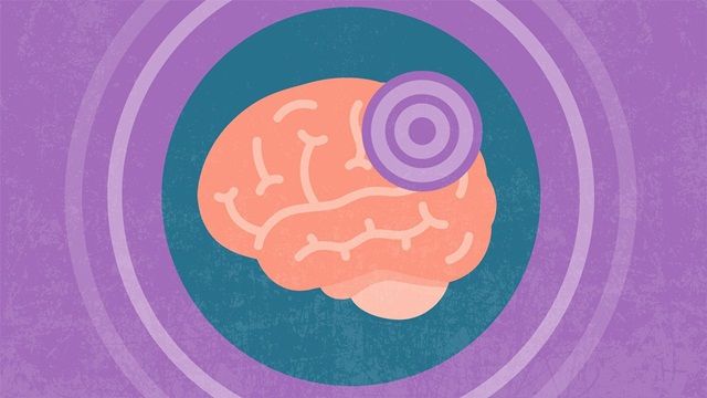 Phân biệt triệu chứng đau nửa đầu và đột quỵ