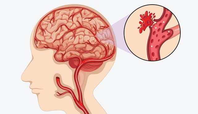 Đột quỵ xuất huyết não: Nguyên nhân, dấu hiệu và tiên lượng