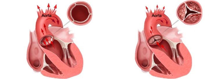 Hẹp eo động mạch chủ: Nguyên nhân, triệu chứng và điều trị