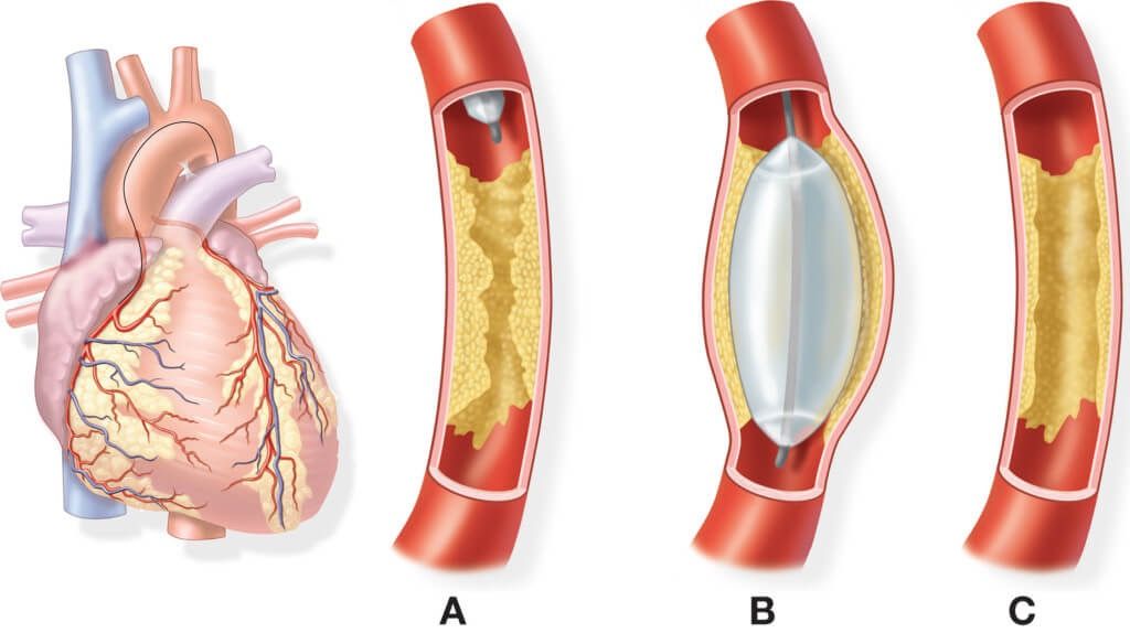 Nong mạch vành sau cơn đau tim có rủi ro và lợi ích gì?