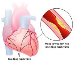 Sự khác biệt giữa đau thắt ngực và bệnh động mạch vành