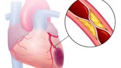 Tìm hiểu về các thủ thuật điều trị bệnh tim mạch ngoại trú