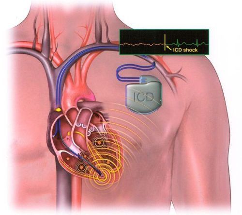 Dấu hiệu và triệu chứng đau tim ở người có dùng máy tạo nhịp tim