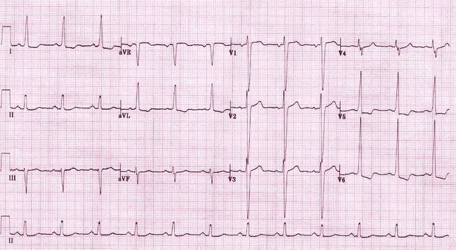 Kết quả điện tâm đồ bất thường