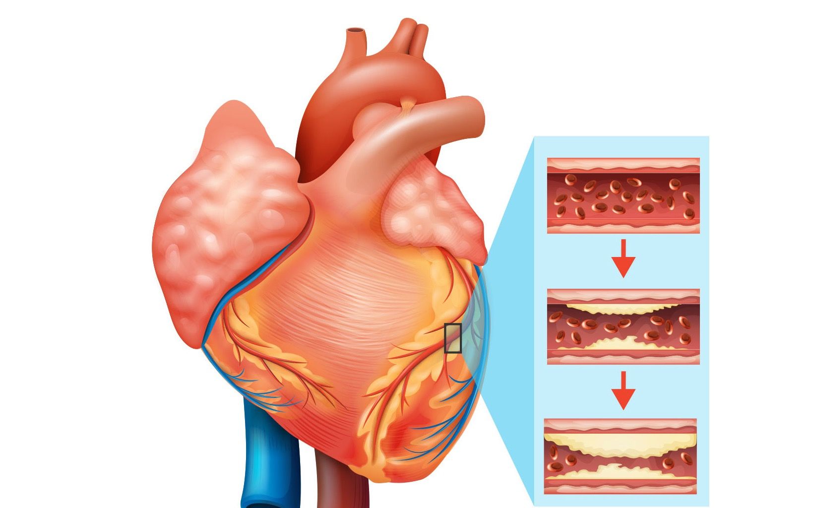 Phân biệt Xơ vữa động mạch và Bệnh động mạch vành