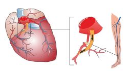 Các phương pháp điều trị bệnh động mạch vành