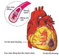 Những điều cần biết về điều trị bệnh động mạch vành