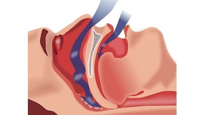 Ngưng thở khi ngủ và bệnh động mạch vành có mối liên hệ như thế nào?