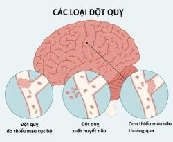 Có những loại đột quỵ nào? Loại nào nguy hiểm nhất?