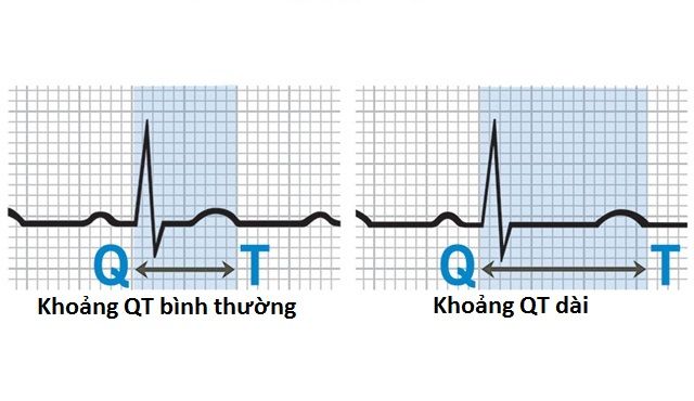 Hội chứng QT dài là gì?