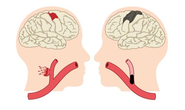 Loại đột quỵ nào có nguy cơ tử vong cao nhất?