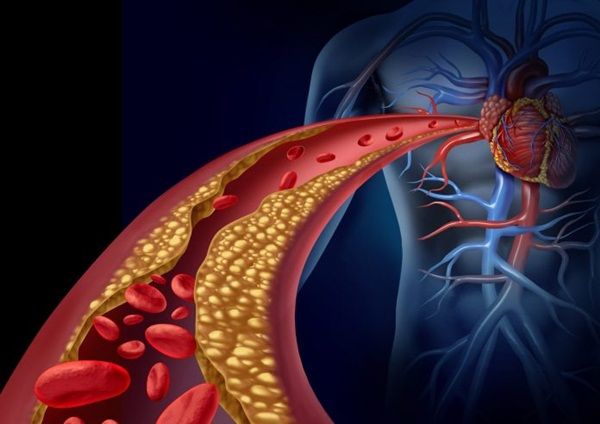 Tăng cholesterole máu có tính gia đình là gì?