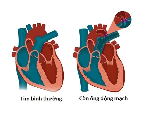 Còn ống động mạch: Triệu chứng, biến chứng và cách điều trị