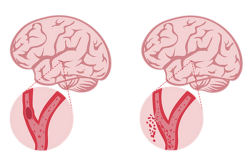 Phân biệt đột quỵ do thiếu máu cục bộ và đột quỵ xuất huyết não