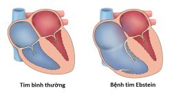 Bệnh tim Ebstein: Nguyên nhân, triệu chứng và điều trị