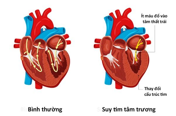 Suy tim tâm trương và suy tim sung huyết có gì khác nhau?