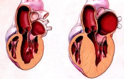 Các triệu chứng và dấu hiệu sớm của bệnh cơ tim phì đại