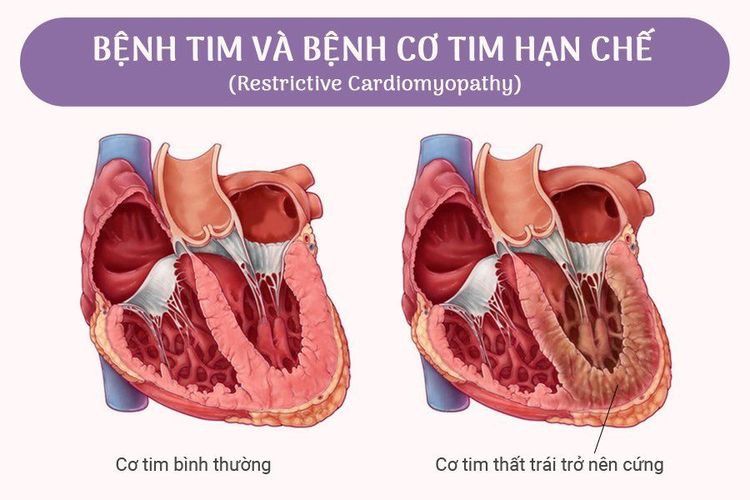 Bệnh cơ tim hạn chế (RCM) là gì?