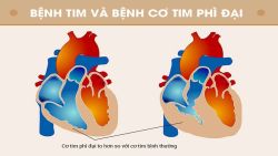 10 câu hỏi về bệnh cơ tim phì đại