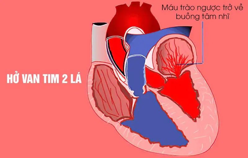 Các dấu hiệu nhận biết hở van tim là gì?