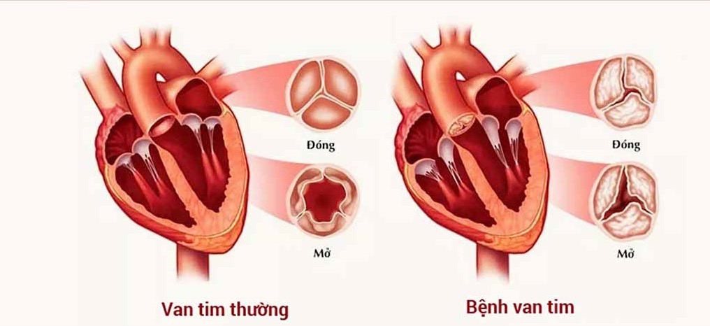Thay van tim không cần phẫu thuật tim hở