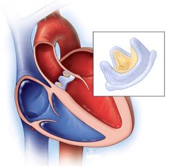 Hẹp van động mạch chủ: Nguyên nhân, triệu chứng và cách điều trị