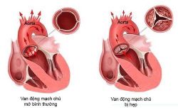 Điều trị hẹp van động mạch chủ không cần phẫu thuật