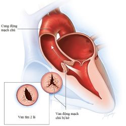 Hở van động mạch chủ: Triệu chứng và phương pháp điều trị