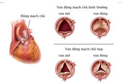 Hẹp van động mạch chủ tiến triển nhanh như thế nào?