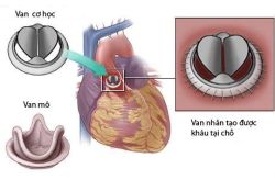 Những điều cần biết về phẫu thuật thay van hai lá